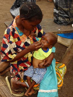 "i capelli gialli sono segno di malnutrizione", centro nutrizionale, Djuma